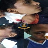 انفجار مقذوف حوثي في 3 أطفال شمال الضالع