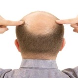 دراسة تربط بين تناول الرجال عصائر محلاة بالسكر والصلع