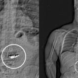 في حادثة مثيرة.. لص يسرق ويبتلع أقراطا بقيمة 770 ألف دولار(فيديو)