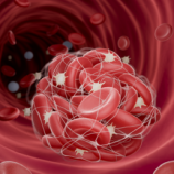 ثورة طبية جديدة.. تقنية مبتكرة لإزالة جلطات الدم بفعالية مذهلة