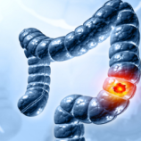 سرطان القولون يهاجم الأجيال الشابة.. لغز طبي يثير القلق العالمي