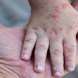 مخاطر تناول مضادات الحيوية في علاج فيروس كوكساكي