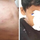 الحديدة .. تزايد حالات الإصابة بفيروس الجدري المائي وسط تجاهل صحة الحـوثي