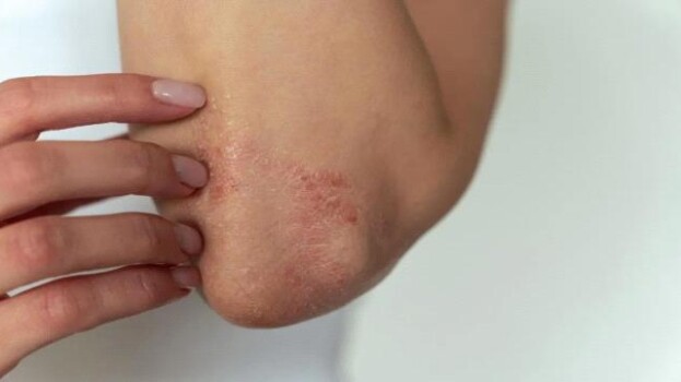 التهاب الجلد التأتبي: ما وراء الحكة.. اضطرابات النوم والذاكرة